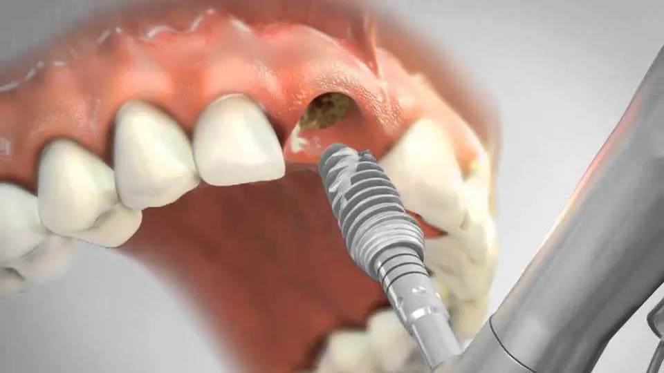 Dikişsiz İmplant Fiyatları Ankara